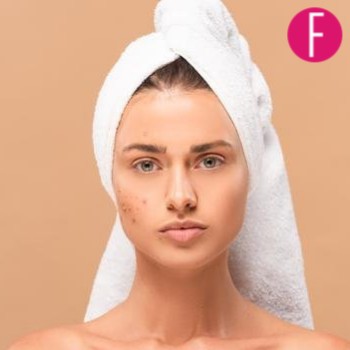 prevent acne, how to prevent acne