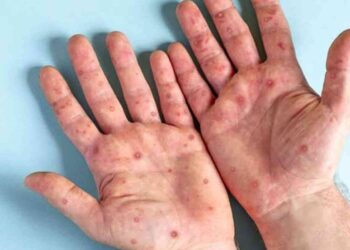 Monkeypox