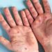 Monkeypox