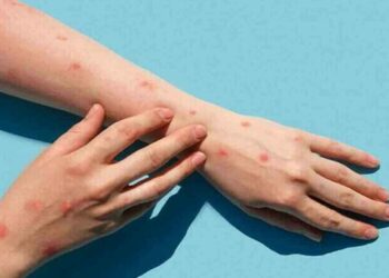 Mpox In Pakistan: 14 Cases & 5 Deaths Reported In Sindh - Here’s Everything You Need To Know