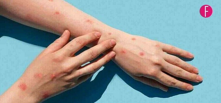 Mpox In Pakistan: 14 Cases & 5 Deaths Reported In Sindh - Here’s Everything You Need To Know